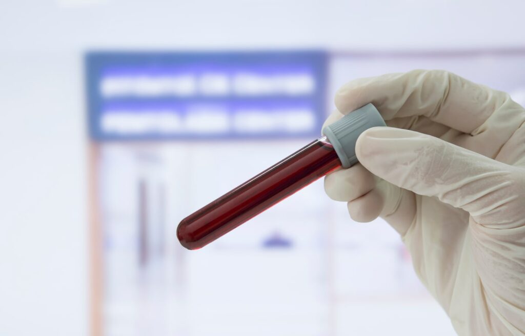 Blood test for Alzheimer’s detected cases with 90% accuracy