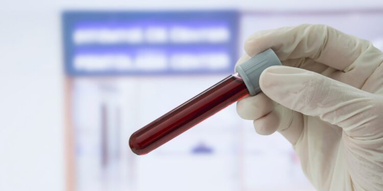 Blood test for Alzheimer’s detected cases with 90% accuracy